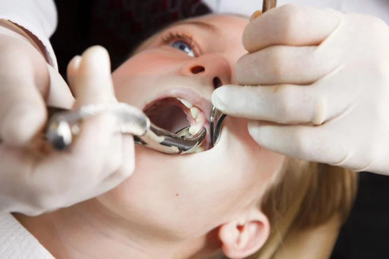 Emergency Wisdom Tooth Removal: What To Do In A Pinch