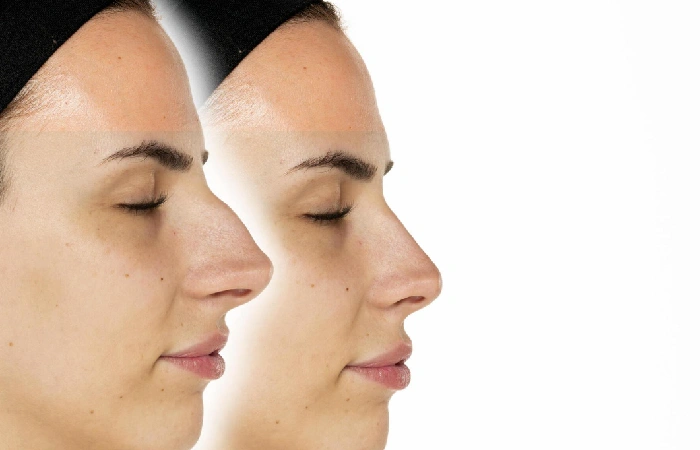 What Is Rhinoplasty Transformation