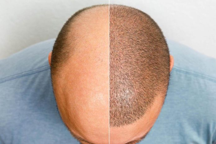Hair Graft