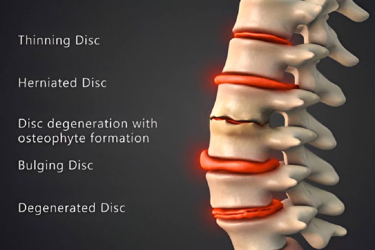 Disc Herniation: The No‑Drama Guide to Pain, Recovery