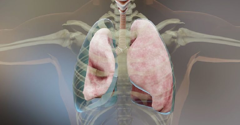 Can Rheumatoid Arthritis Affect The Lungs?