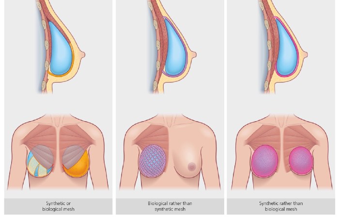 tissue expander and implant reconstruction stages visual