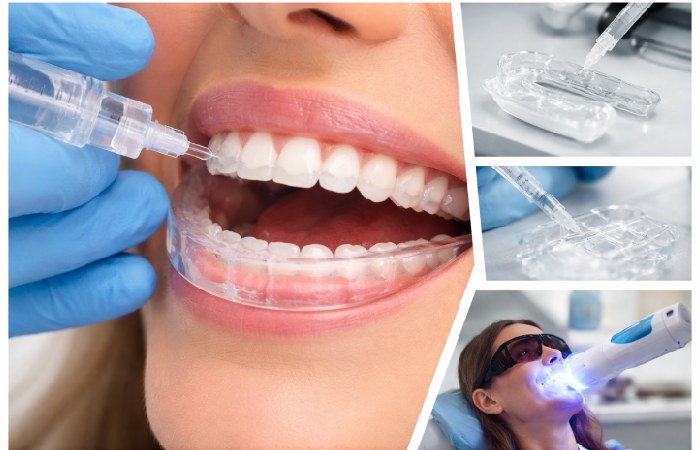Dentist applying whitening gel to teeth demonstrating peroxide-based bleaching process