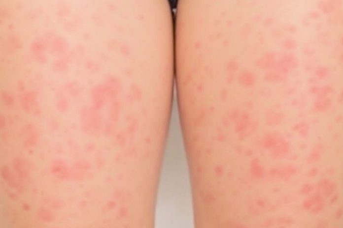 How to Get Rid of Strawberry Legs