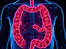 Colon Cancer