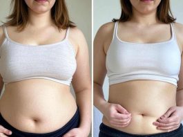 Tummy Tuck